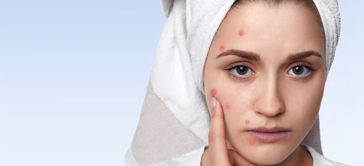 Una donna che lotta contro l'acne