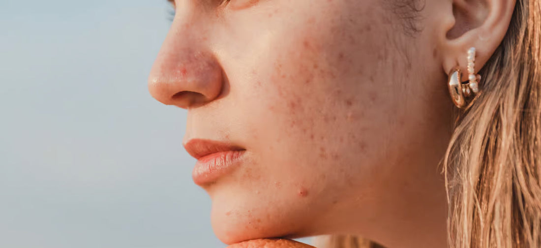 Cicatrici da acne